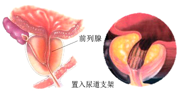 四川省首例TPS前列腺支架置入术成功实施，为更多患者带去福音！