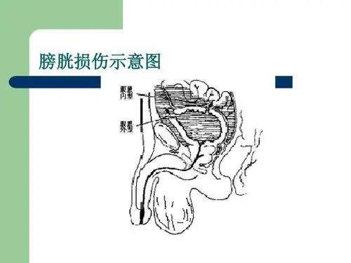 做结扎手术反倒把膀胱整到了?一键了解膀胱损伤