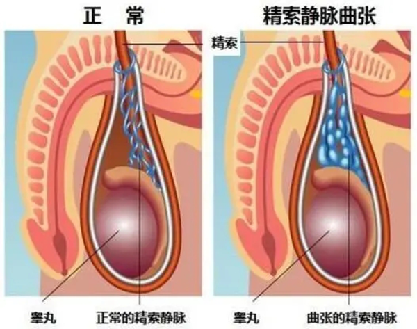 精索静脉曲张|医生：不及时治疗可能会影响生育