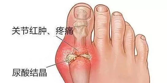 患了痛风,你吃对了吗?