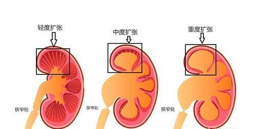 肾积水丨当肾脏里的尿液不能及时排出会发生什么？