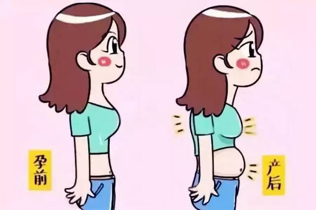 A4腰产后变“泳圈”?腹直肌分离又是啥?