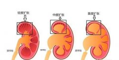 肾积水是什么