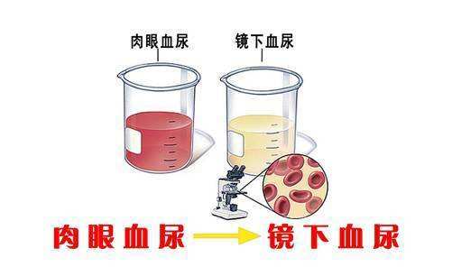 热搜:排队憋尿憋到尿血丨无痛血尿要小心……