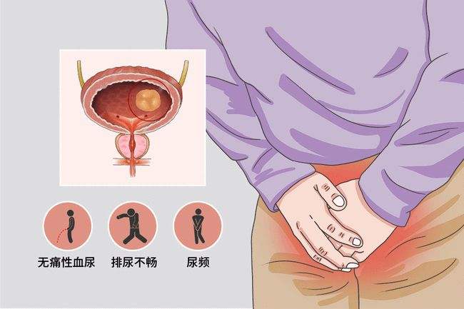 热搜:排队憋尿憋到尿血丨无痛血尿要小心……