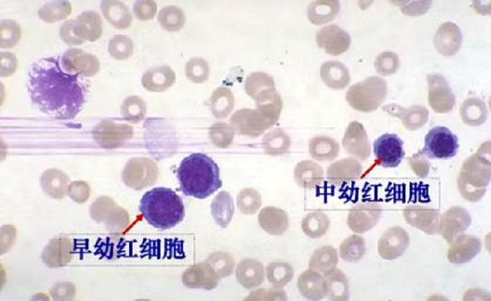 红细胞检测之有核红细胞篇