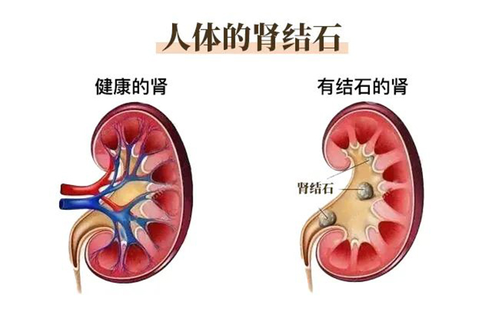 这个医生说“结石痛”是好事