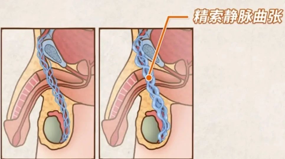 阴囊里的“小蚯蚓”——精索静脉曲张是怎么回事？