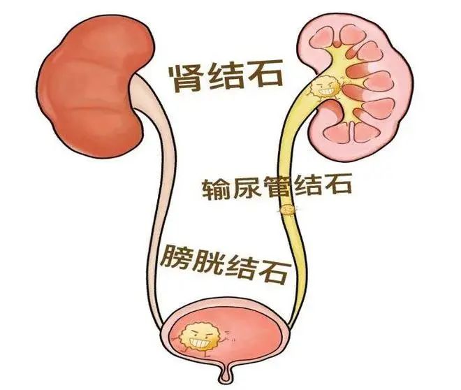 泌尿外科到底看什么病？——揭秘