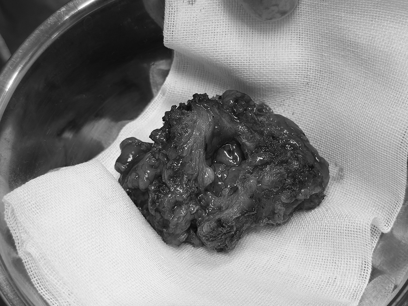 从“老病友”到“新希望” 川泌为血透患者成功根治膀胱癌