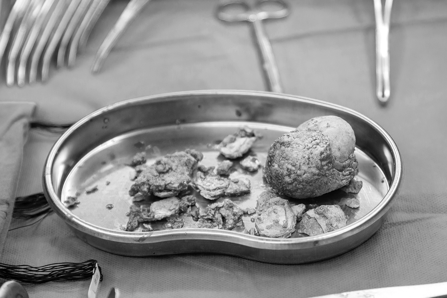 6.5厘米“鹅蛋”巨石成功取出，川泌救治甘孜藏区患者