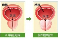 排尿困难8年 最后怎么样了