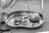 6.5厘米“鹅蛋”巨石成功取出，川泌救治甘孜藏区患者