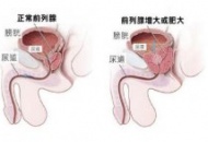 警惕！前列腺疾病应及早就医   避免生活受限