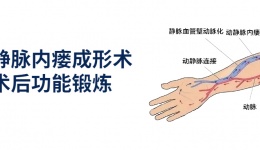 动静脉内瘘成形术术后功能锻炼