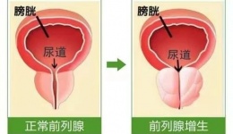 排尿困难8年 最后怎么样了