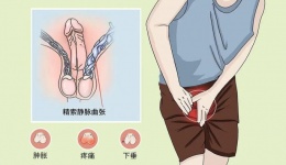 阴囊里的“小蚯蚓”——精索静脉曲张是怎么回事？