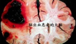 【最全总结】什么是脑出血？