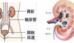 肾积水的治疗