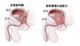 警惕！前列腺疾病应及早就医   避免生活受限