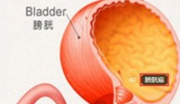 膀胱癌知识之病因