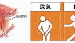 前列腺增生，你怕了吗？
